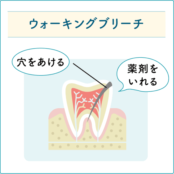 ウォーキングブリーチ