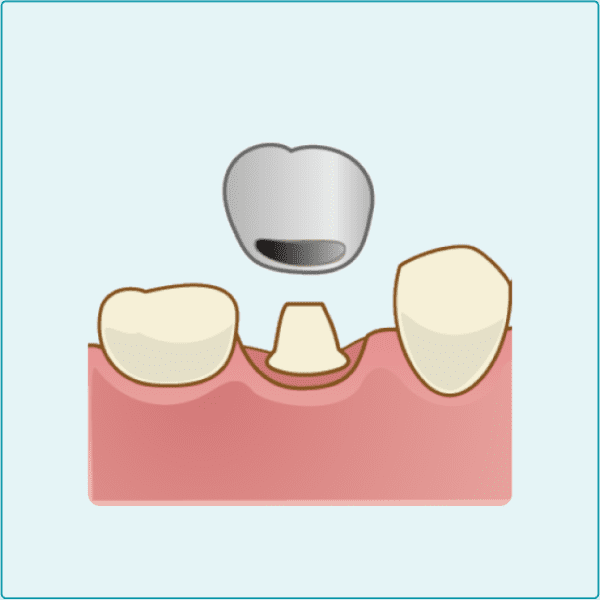 保険の被せ物・銀歯
