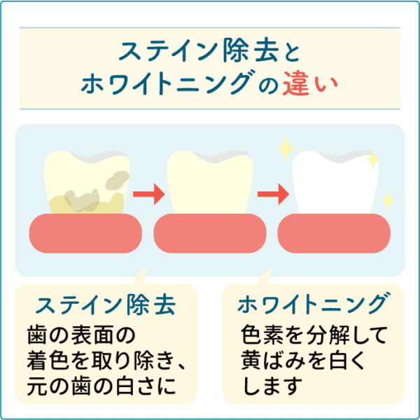 ステイン除去とホワイトニング