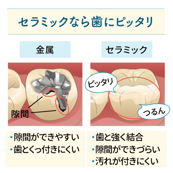セラミックと二次虫歯