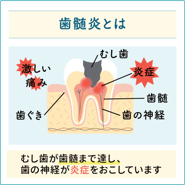 歯髄炎とは