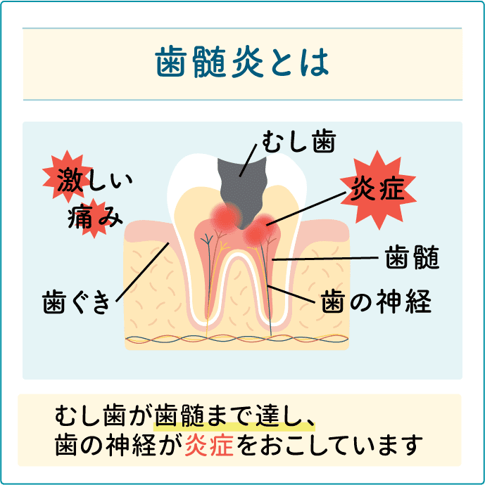 歯髄炎