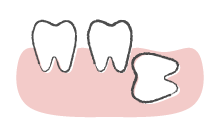 親知らずを抜きたい