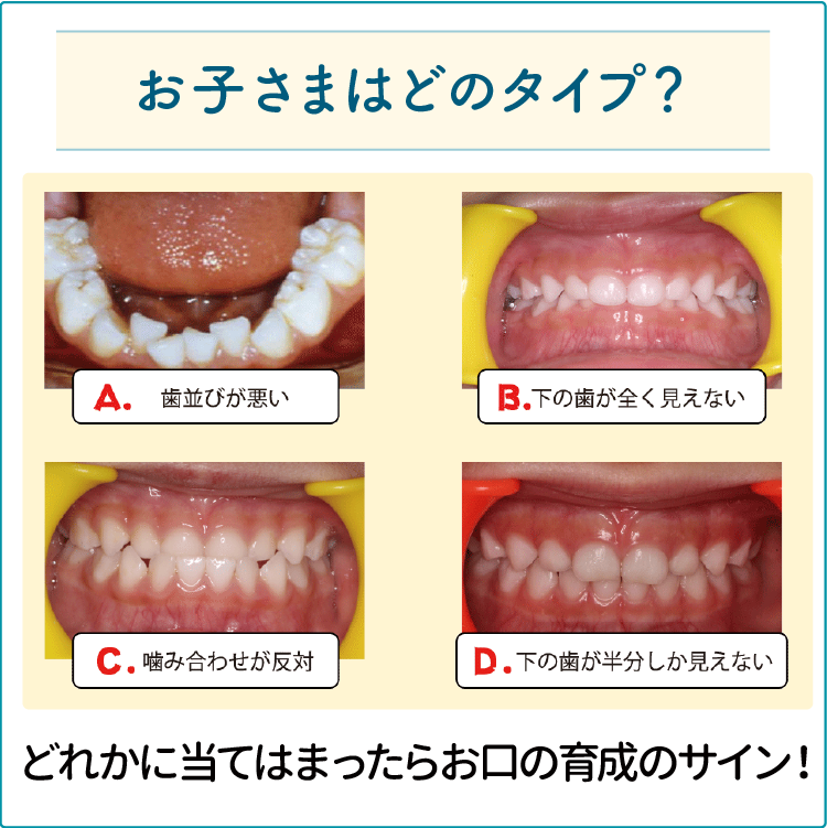 お子さまはどのタイプの歯並び？