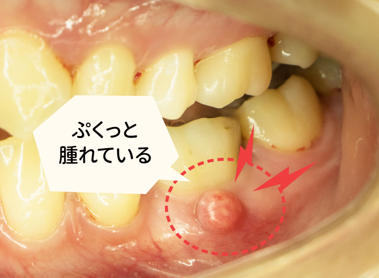 歯ぐきの腫れ-フィステル