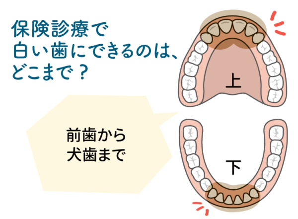 前歯のブリッジ