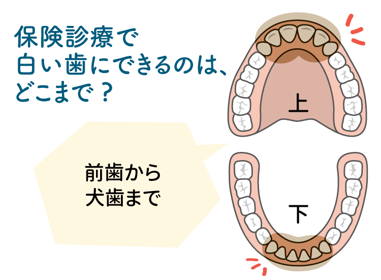 前歯から犬歯までプラスチックの白い歯にできます