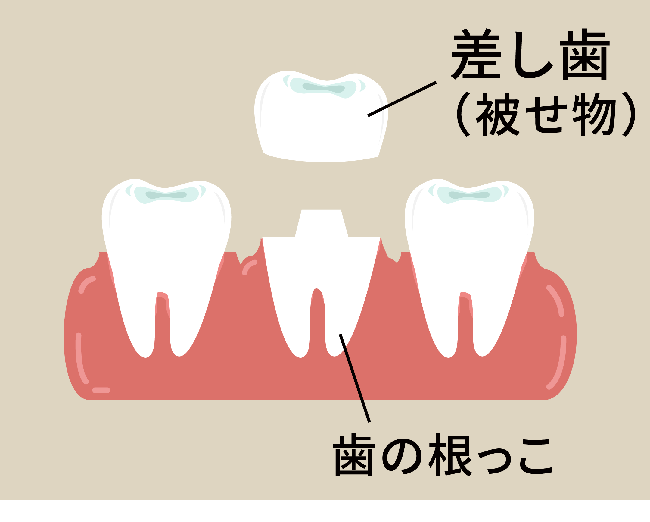 差し歯の治療