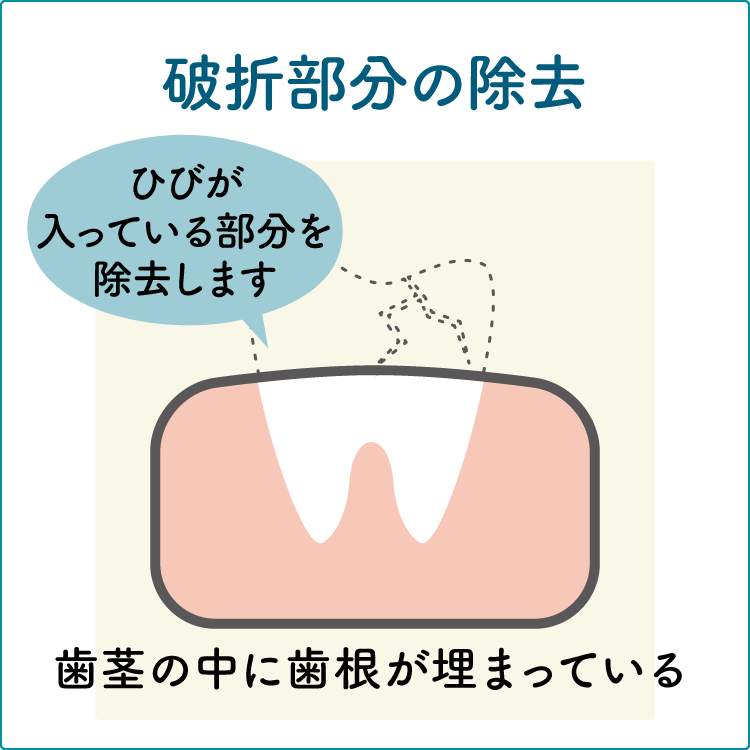 歯冠長延長術の治療1