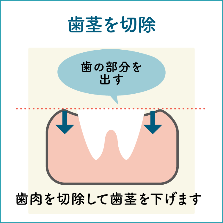 歯冠長延長術の治療2