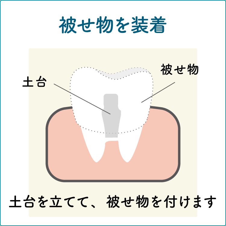 歯冠長延長術の治療3