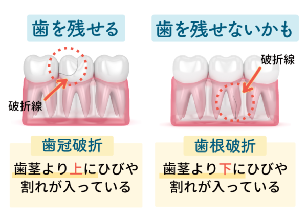 歯の破折の治療方法