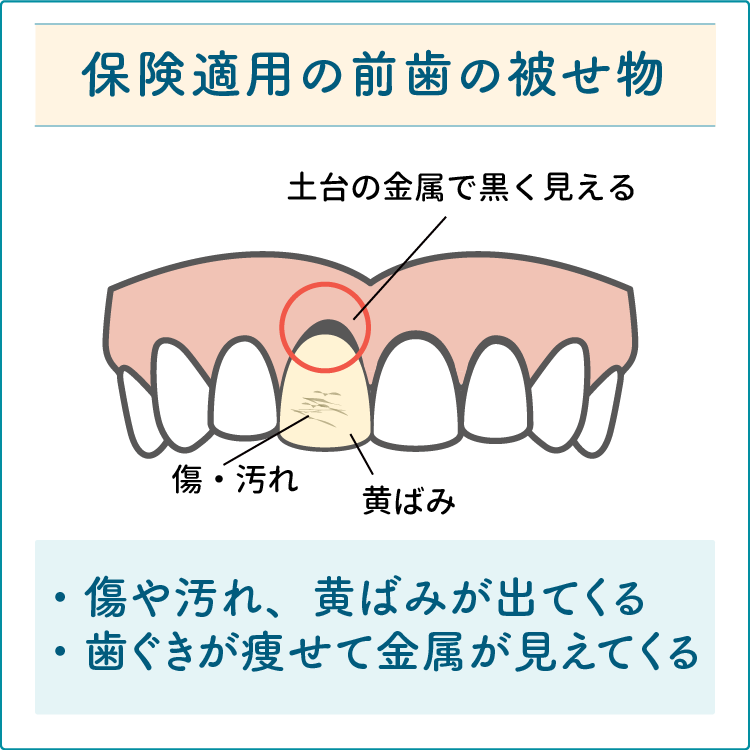 保険適用の前歯の被せ物　差し歯