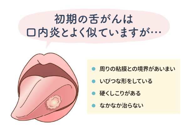 初期の舌がん