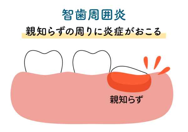 智歯周囲炎