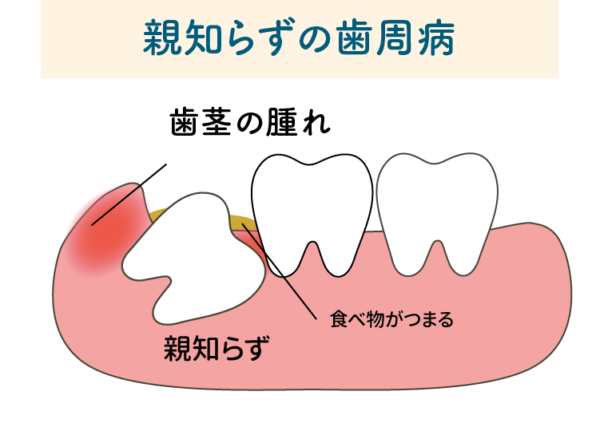 親知らずの歯周病