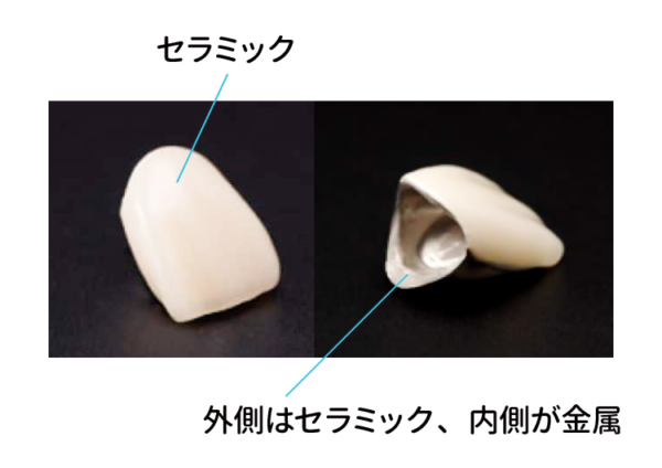 ブリッジメタルボンド