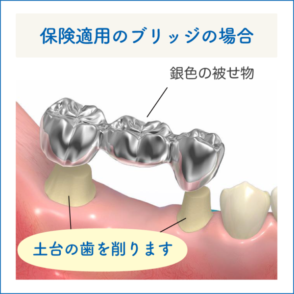 保険のブリッジ