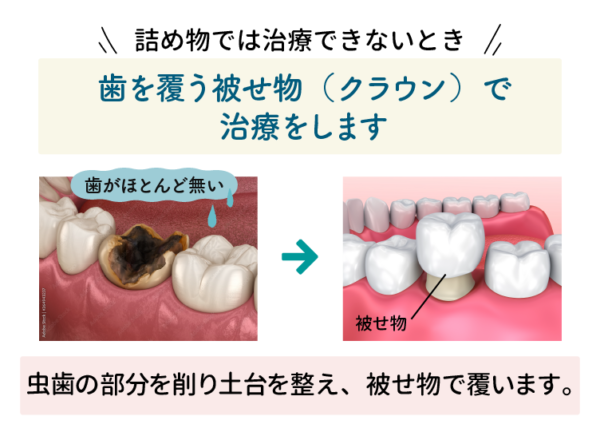被せ物の治療