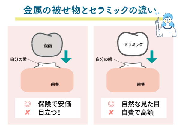 金属の被せ物とセラミックの違い