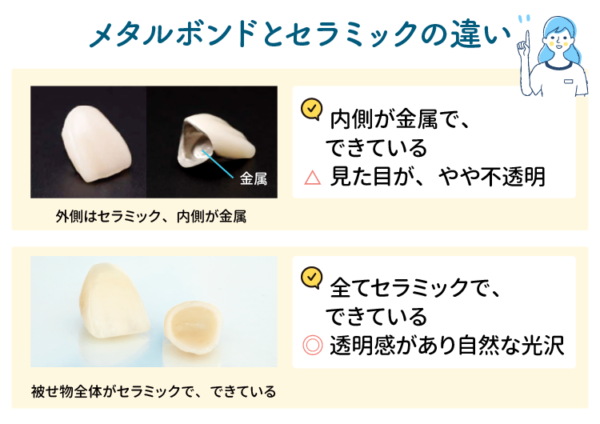 メタルボンドとセラミックの違い