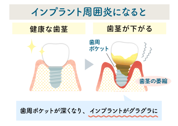 インプラント周囲炎