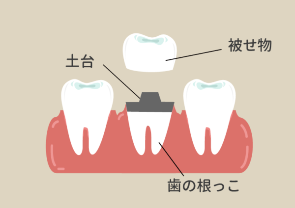 被せ物・crown