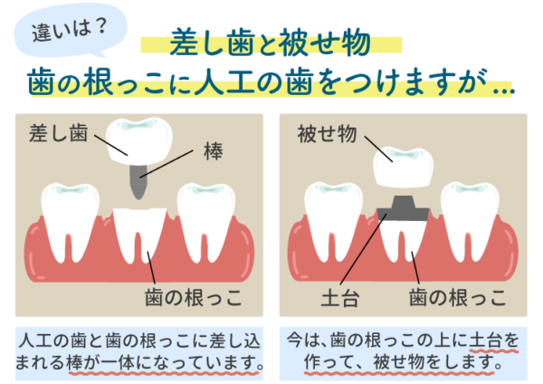 差し歯と被せ物の違い