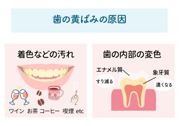 歯の黄ばみの原因