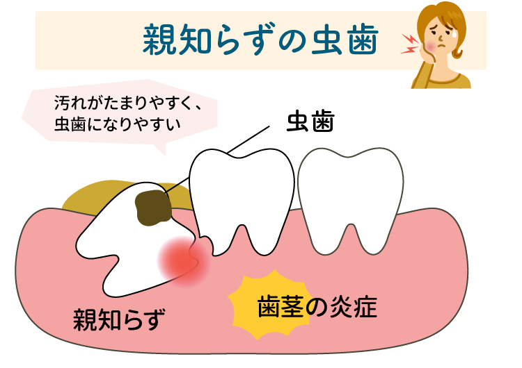 親知らずの痛み