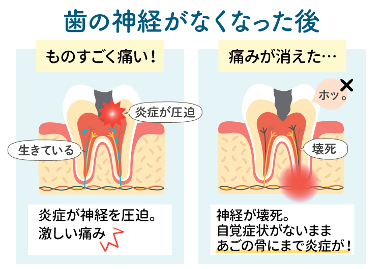 歯の神経がなくなると