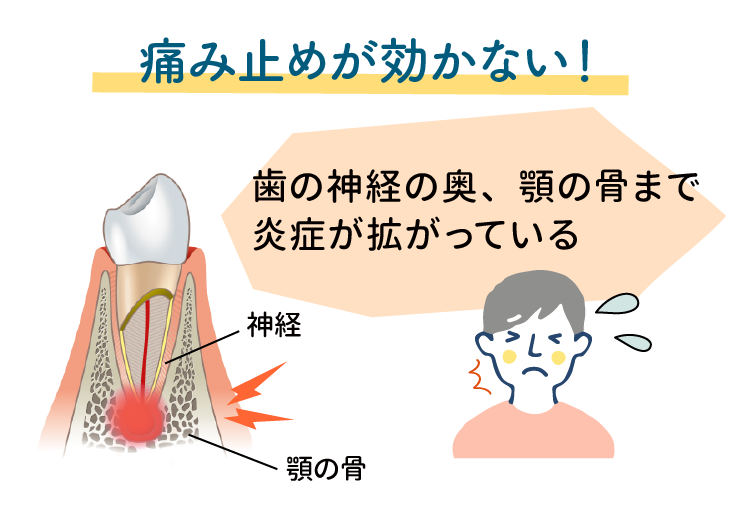 痛み止めが効かない