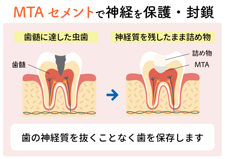 マイクロスコープを使用した精密治療